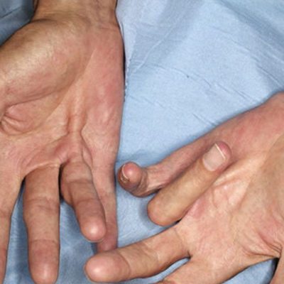 Dupuytren’s-Contracture-Dubai-Aestheticon.jpg